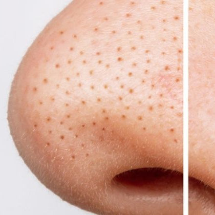 How To Remove Blackheads Safely Without Much Pain 