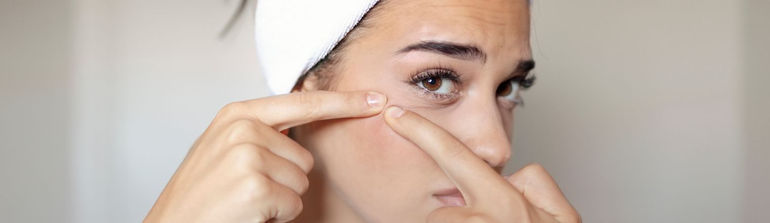 Essential Skincare Tips for Acne-Prone Skin During Monsoon