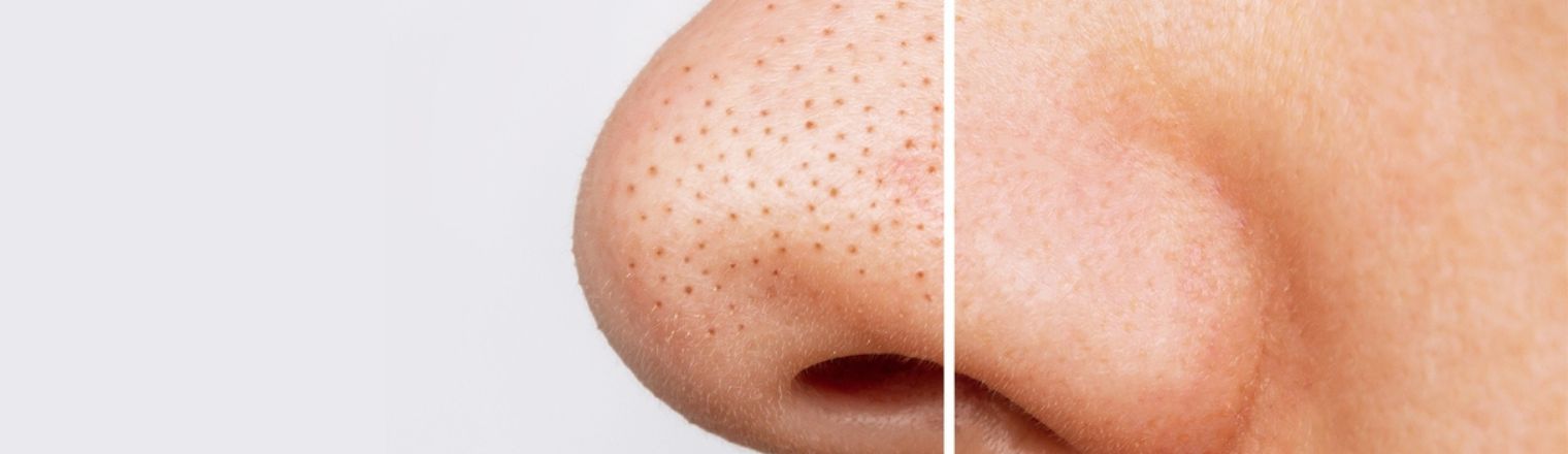 Nose Blackheads Be Gone: Tips for a Clear Complexion - Lifestyle Changes