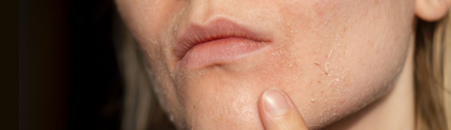 How To Take Care Of Dry Skin In Humid Weather Or Monsoon?