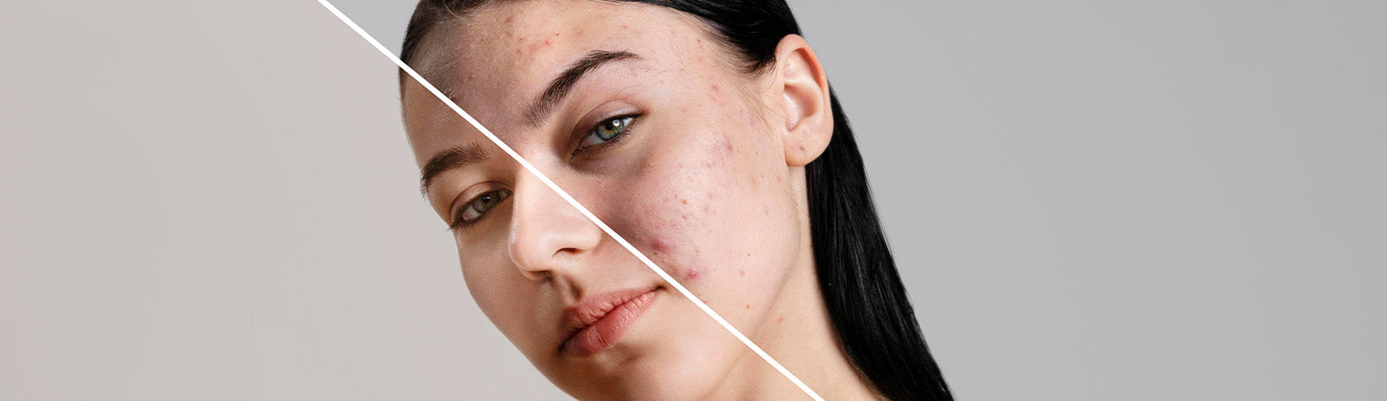 Skin Barrier: What Is It & How To Keep It Strong